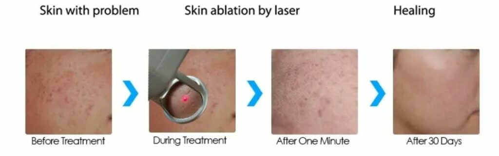 How does fractional co2 laser work for skin resurfacing?